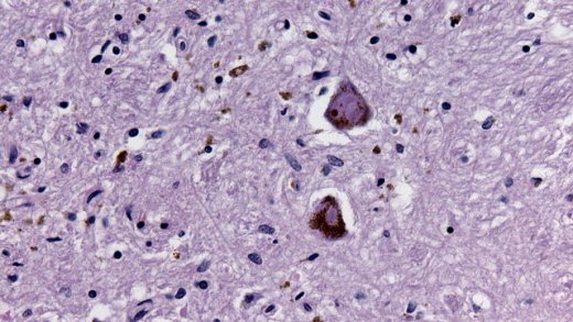 Kouření snižuje riziko vzniku Parkinsonovy choroby Kouření snižuje riziko vzniku Parkinsonovy choroby